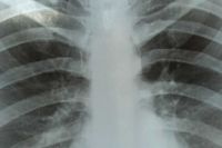 Центр здоровья  Хакасии приглашает на обследование лёгких